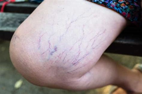 15 Common Causes of Spider Veins You Shouldn't Ignore - OptingHealth