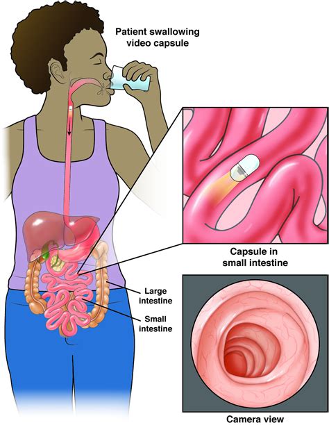 Small bowel capsule endoscopy - AGA GI Patient Center