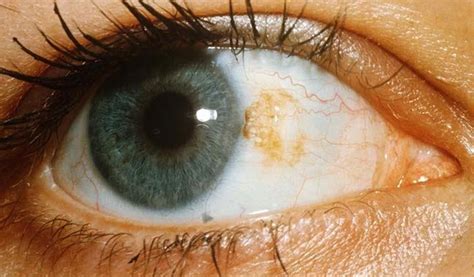 Ocular Melanoma Pictures – 27 Photos & Images / illnessee.com