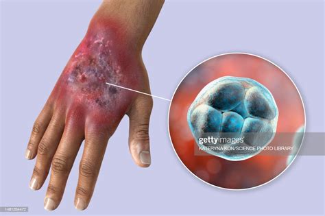 Protothecosis Infection On A Human Hand Illustration High-Res Vector Graphic - Getty Images