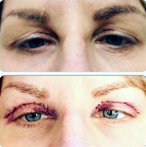 Suture Blepharoplasty Recovery Time » Eyelid Surgery: Cost, Photos, Rewiews, Q&A