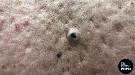 Dr. Pimple Popper -- See The KING Of All Blackheads Explode