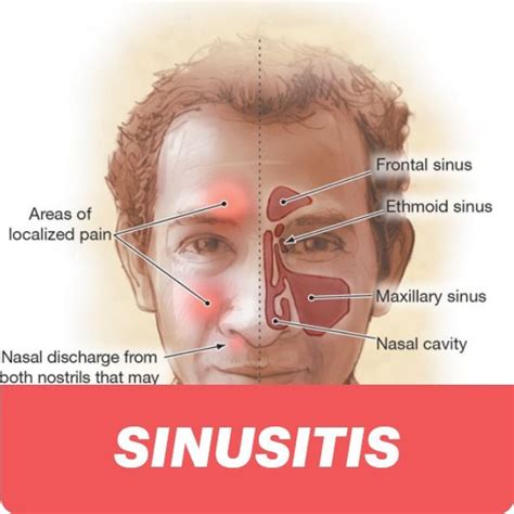 Sinusitis- types, causes, symptoms complications | Sinus headache, Sinusitis, Sinusitis causes