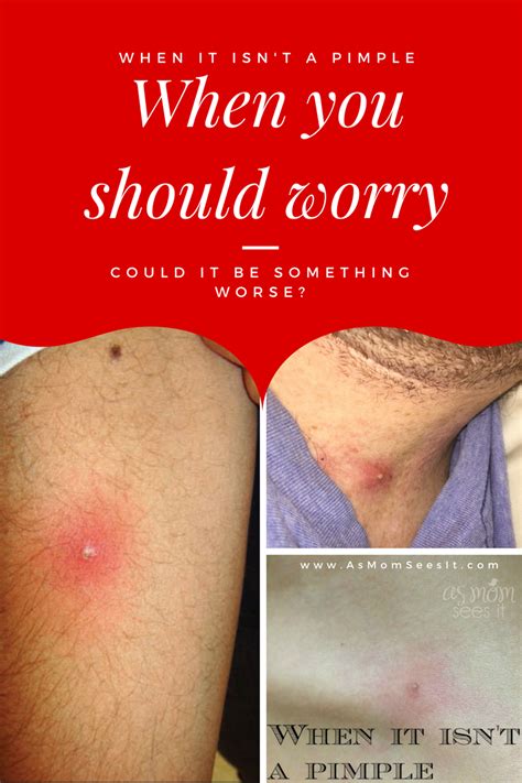 When A Pimple Is Something Worse: Could It Be MRSA? | Fungal infection skin, Spider bite ...