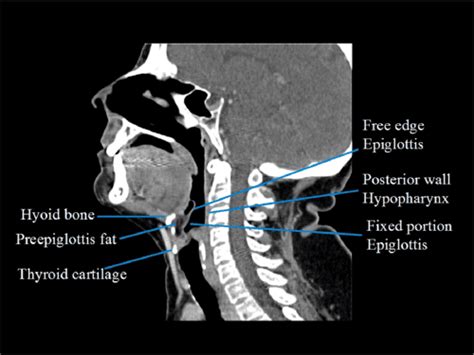 Figure 10 from Hypopharynx and larynx anatomy | Semantic Scholar