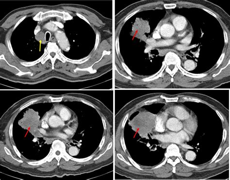 Lung cancer: squamous cell carcinoma – Radiology Cases