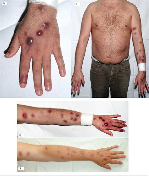 Mycobacterium Skin Lesions