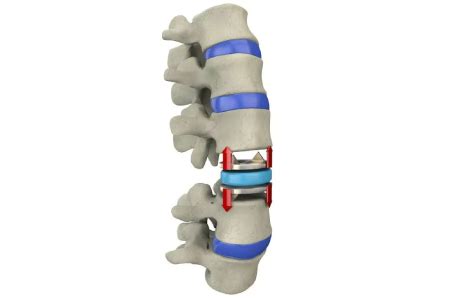 Cervical Disc Replacement Surgery Cost in India