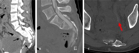 Lumbar spine CT myelogram obtained on postoperative day 20 due to... | Download Scientific Diagram