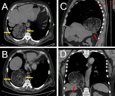 Pulmonary Hamartoma