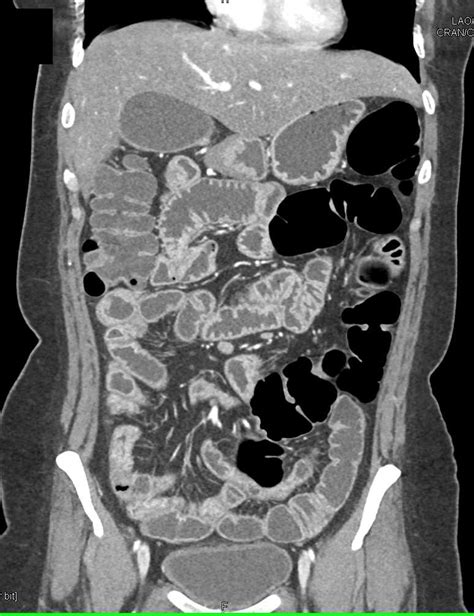 Thickened Small Bowel Loops due to Inflammatory Bowel Disease (IBD) - Small Bowel Case Studies ...