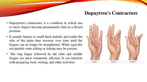 Claw hand,causes,types,symptoms,management