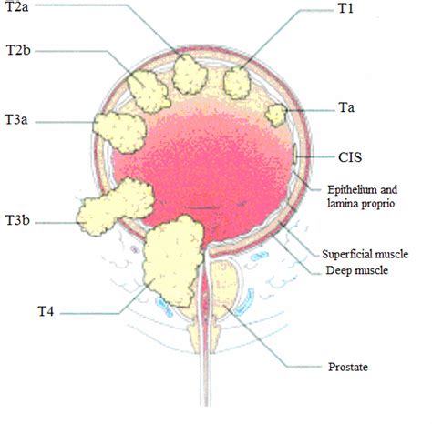 Stages of bladder cancer from Meyer et al., (2002). Bladder cancer can ...