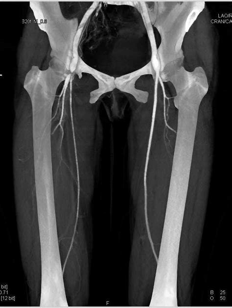 Critical Stenosis of the Right SFA with CTA - Vascular Case Studies - CTisus CT Scanning