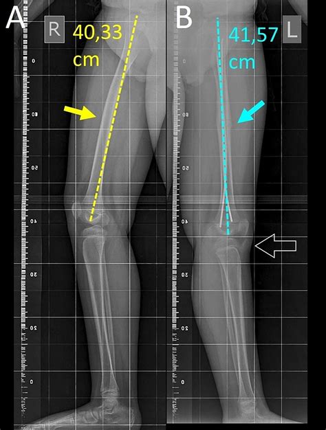 Cureus | Leg Length Discrepancy Due to Loss of Femoral Antecurvatum ...