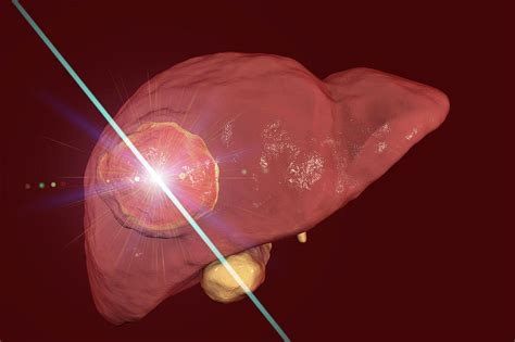 Liver Cancer Treatment With Laser Photograph by Kateryna Kon/science Photo Library - Fine Art ...