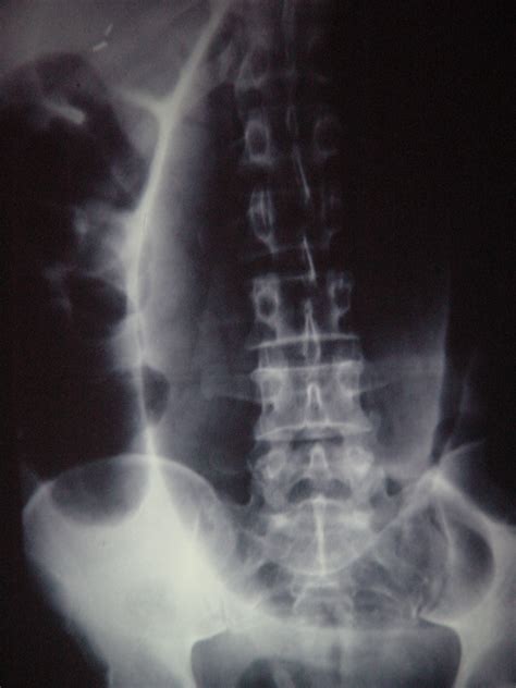 Colon Volvulus Sigmoid 2213 Slides 041 | Surgery Photos