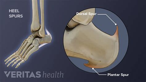 Spur In Achilles Tendon | atelier-yuwa.ciao.jp