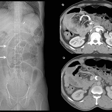 Contrast-enhanced CT shows encapsulated clustered bowel loops (c)... | Download Scientific Diagram