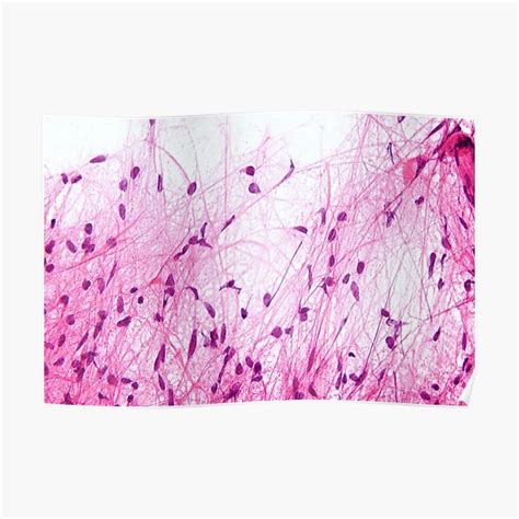 Astrocytoma Histology Premium Matte Vertical Poster