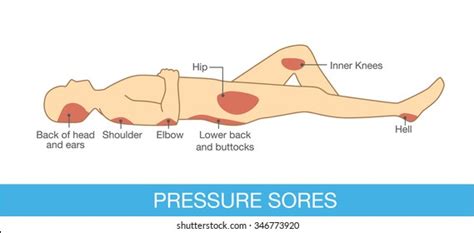 Pressure Sores Photos, Images & Pictures | Shutterstock