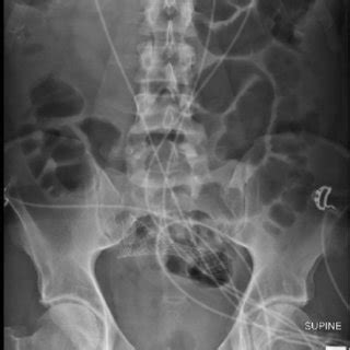 Post procedure X-ray colonic stent (sigmoid colon). | Download Scientific Diagram