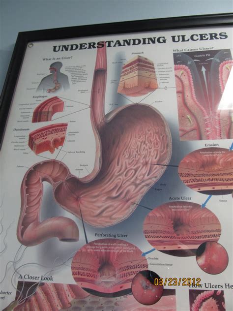 PrunePicker: Dilation of the esophagus.