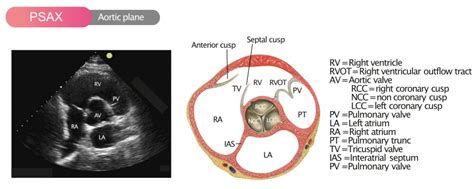 Standard Transthoracic Echocardiogram: Complete Imaging Protocol – ECG & ECHO