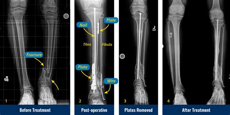 Tibia And Fibula Fracture Surgery