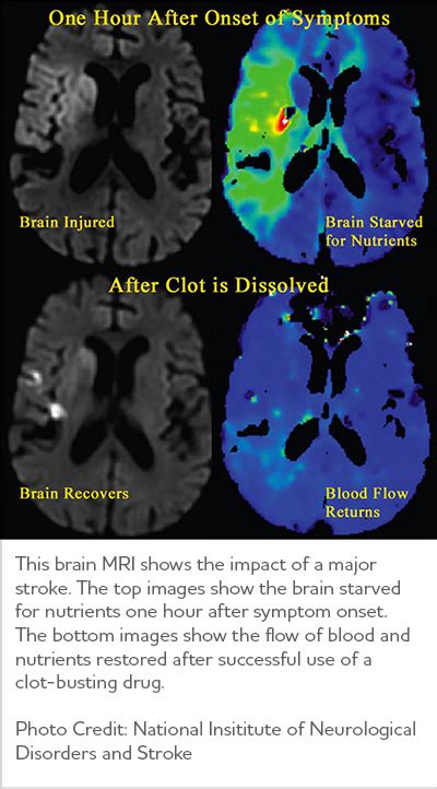 Vascular Dementia | Symptoms & Treatments | alz.org