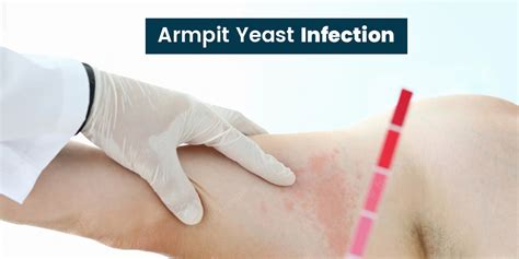 Armpit Yeast Infection| Symptoms Causes Prevention Tips | Onlymyhealth