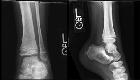 AP and Lateral radiographs of the left ankle reveal soft tissue ...