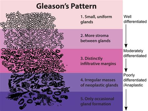 Gleason grading system - Wikipedia