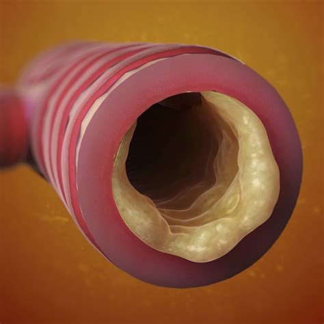 Images of How COPD Looks Inside of Lungs