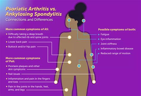 Psoriatic Arthritis vs. Ankylosing Spondylitis: Connections and ...