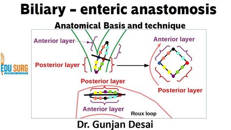 Roux-en-Y hepaticojejunostomy - anatomical basis and steps of surgery - Biliary-enteric ...