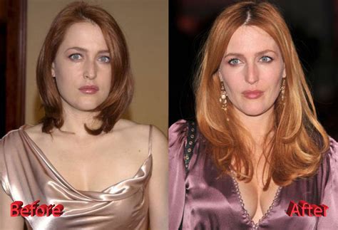 Gillian Anderson Plastic Surgery: Before and After