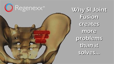 Si Joint Fusion Success Rate | Science Relief