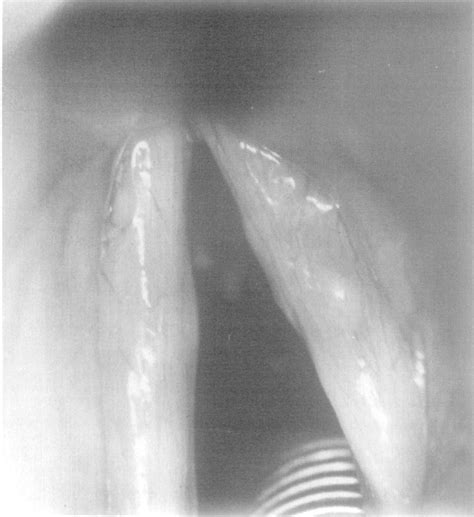 Rheumatoid Nodules of the Larynx | Semantic Scholar