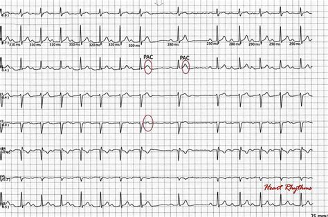 ECG Rhythms: Atypical Wenckebach interrupted by bigeminal PAC's