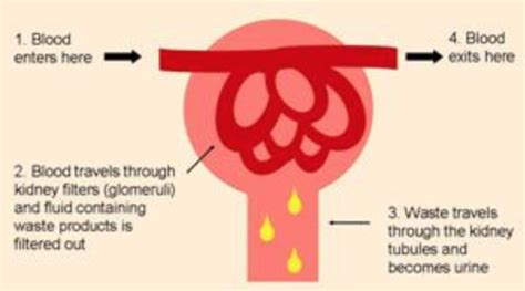 ANCA Associated Vasculitis and the Kidney - Vasculitis UK