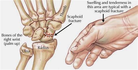 HAND AND WRIST SURGERY - Dr Narender Saini : Scaphoid bone fracture in the Wrist- A common ...