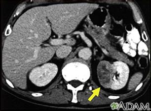 Kidney tumor - CT scan: MedlinePlus Medical Encyclopedia Image