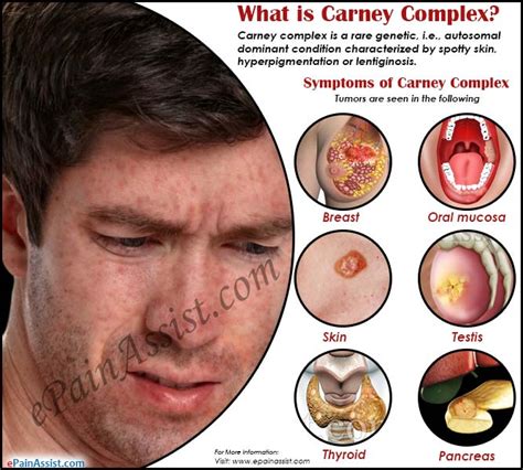 What is Carney Complex|Causes|Symptoms|Treatment|Prognosis|Pathophysiology