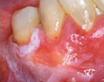 White Spots on Gums Pictures, Causes, Treatment for Painful Small White Dots, Patches on Gums ...