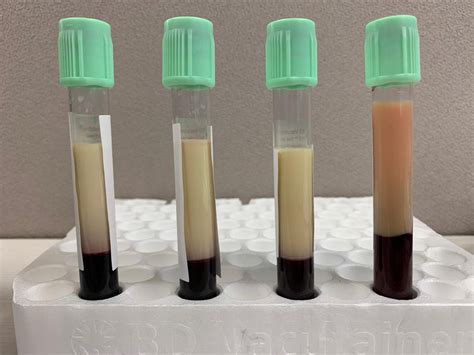 Demonstration of patient's blood separating into two distinct layers... | Download Scientific ...