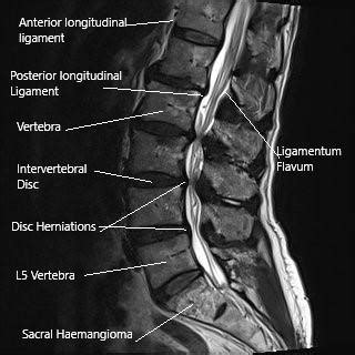 Lumbar Laminectomy Surgery - Complete Orthopedics | Multiple NY Locations