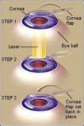 Lasik & Refractive Surgery, रिफ्रैक्टिव सर्जरी सर्विस, रेफ्रेक्टिव सर्जरी सर्विस, रेफ्रेक्टिव ...