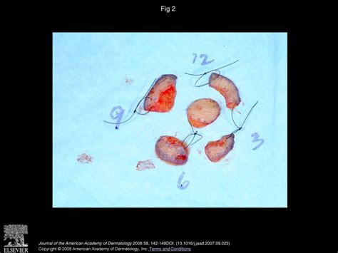 Staged excision for lentigo maligna and lentigo maligna melanoma: A ...