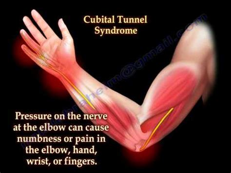 Cubital Tunnel Syndrome Surgery Ulnar Nerve Entrapment